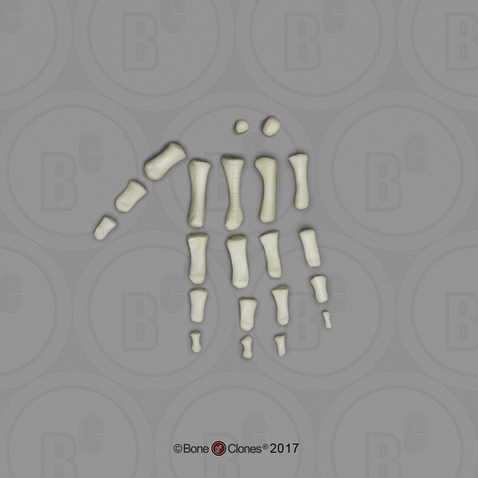 14 mo Child Hand Disarticulated