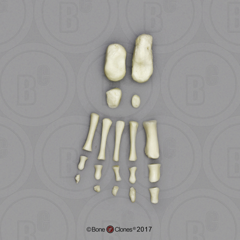 14 mo Child Foot Disarticulated