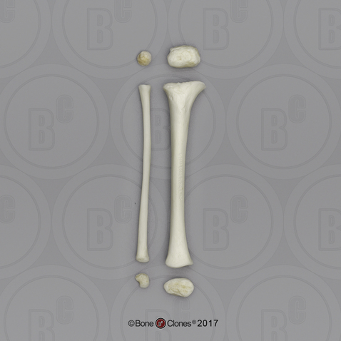 14 mo Child Tibia and Fibula