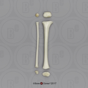 14 mo Child Tibia and Fibula