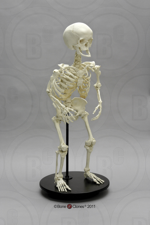 Human Female Achondroplasia Dwarf Skeleton, Articulated