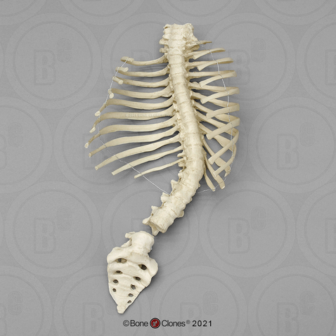 Human Child Vertebra, Ribs and Sacrum Scoliosis