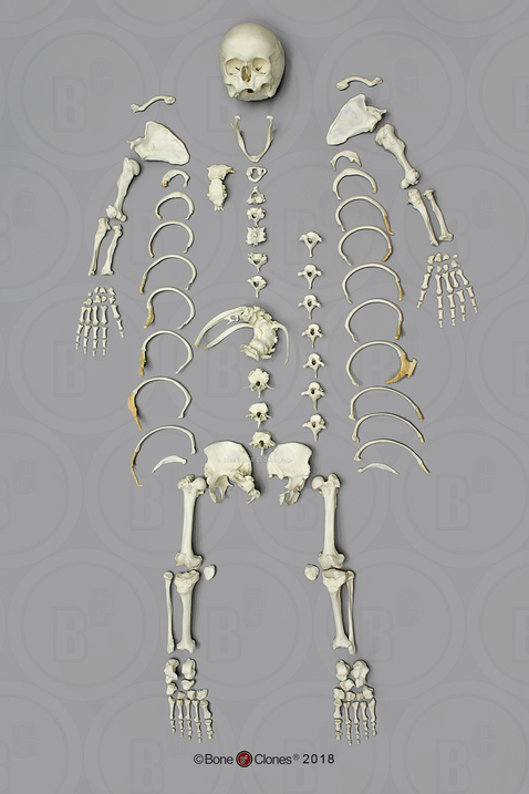 Human Female Achondroplasia Dwarf Skeleton, Disarticulated