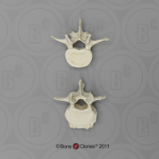 Comparative Lumbar (L-3) Vertebra Set of 2 (Arthritic and  Normal)