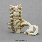 Human 68-year-old Male Fused  C-4 Through T-3 and 2 Ribs