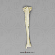 Healed Left Tibia Fracture