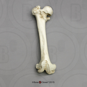 Human Female Achondroplasia Dwarf Femur