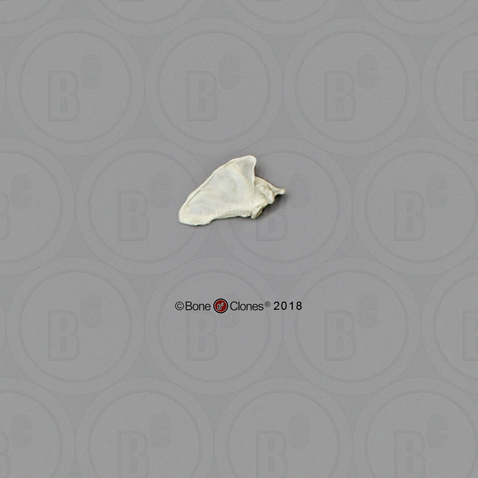 Human Female Achondroplasia Dwarf Scapula