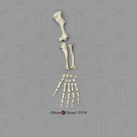 Human Female Achondroplasia Dwarf Arm, Disarticulated without Scapula