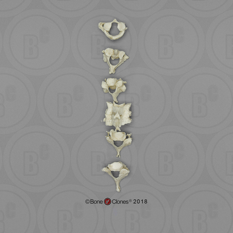 Human Female Achondroplasia Dwarf Cervical Vertebrae, Set of 7