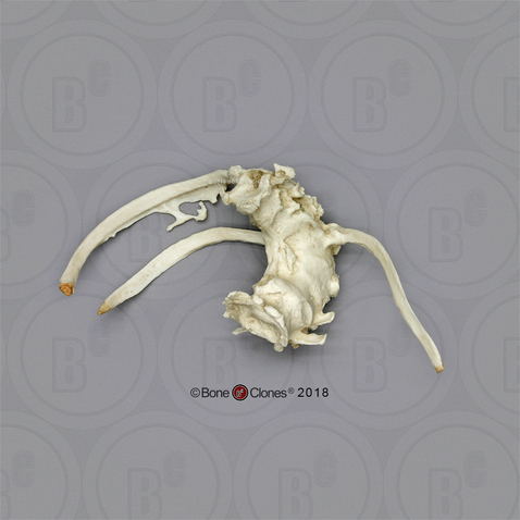 Human Female Achondroplasia Dwarf Fused Vertebrae and Ribs