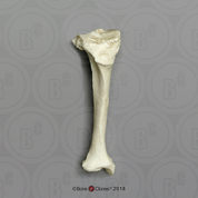 Human Female Achondroplasia Dwarf Right Tibia