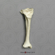 Human Female Achondroplasia Dwarf Right Tibia