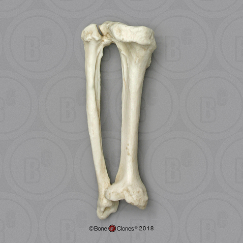 Human Female Achondroplasia Dwarf Left Tibia and Fibula, Fused