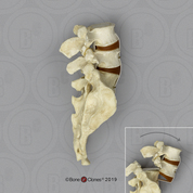 Spondylolisthesis Model