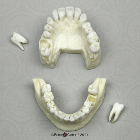 Human Teeth, Removable on Partial Mandible and Maxilla