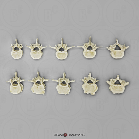 Comparative Lumbar Vertebra Set of 10 (Arthritic and Normal)