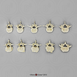 Comparative Lumbar Vertebra Set of 10 (Arthritic and Normal)