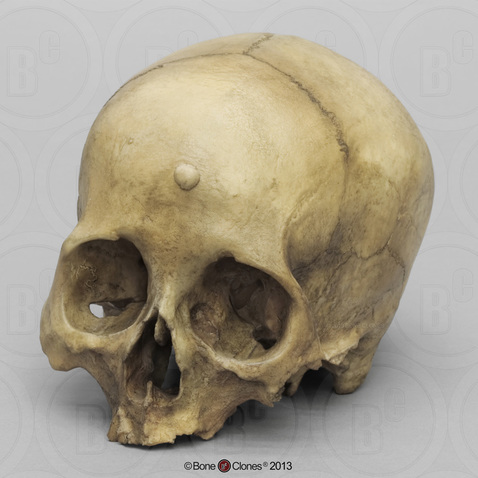 Human Female Cranium with Button Osteoma